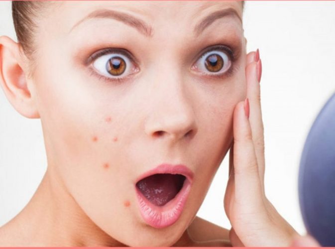 6 Best Ayurvedic Treatment For Pimples – Simple Home Remedies